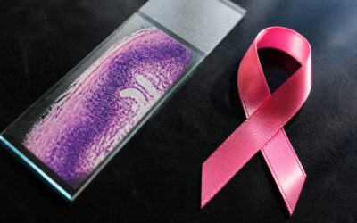 Cancerul de sân este diagnosticat de 25 de ori mai des decât cancerul de col uterin