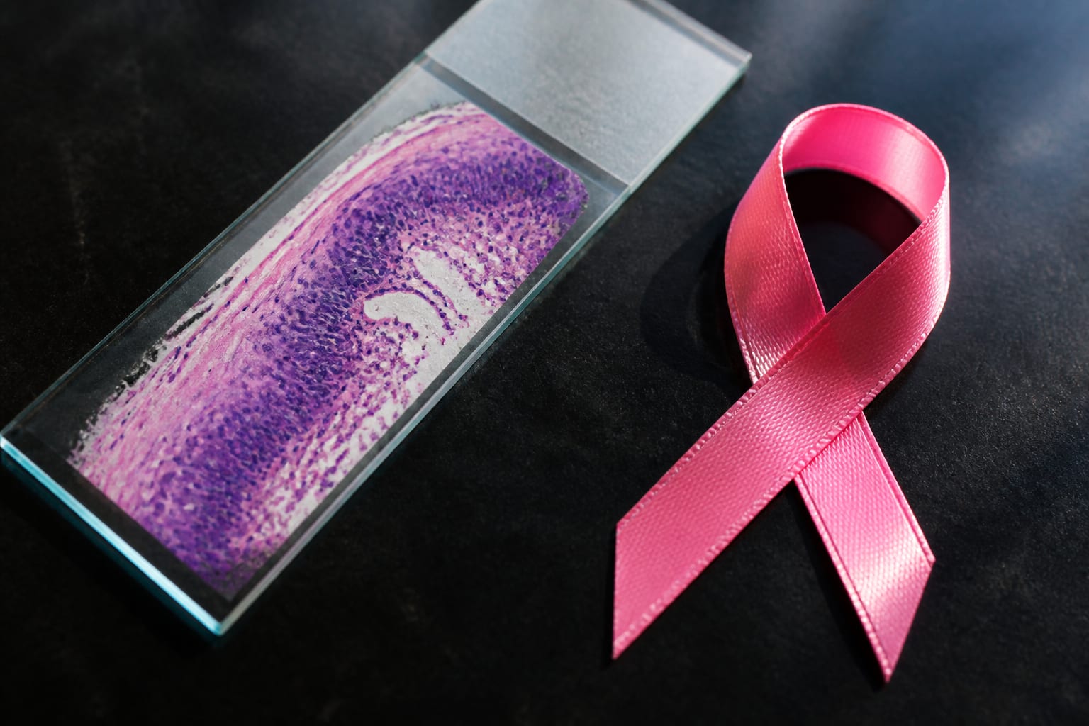 Cancerul de sân este diagnosticat de 25 de ori mai des decât cancerul de col uterin