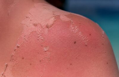 Cinci arsuri solare pot dubla riscul de melanom, avertizează medicii